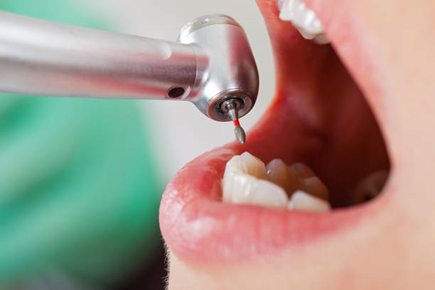 Best Broken or Chipped Tooth Repair in Vineland, NJ